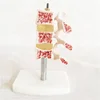 Typical lesion model of vertebrae spinal anatomy model for teaching