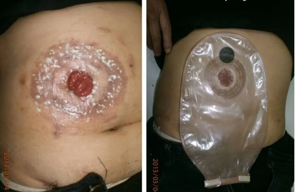 Popular Ostomy-Buy Cheap Ostomy lots from China Ostomy