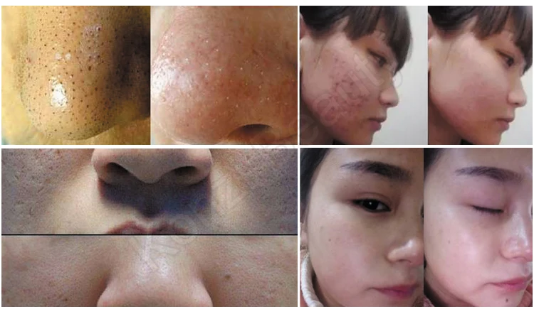 dermabrasion facial