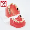 Caries Treatment Model before & after comparision