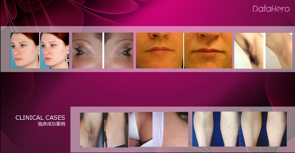 IPL SHR /SHR IPL /IPL hair removal, professional laser hair removal machine