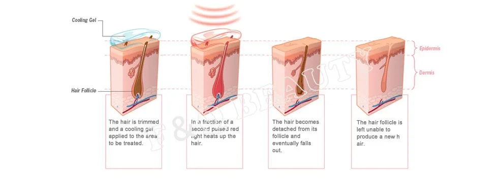 FQA20-8 Wrinkle rejuvenation  hair removal machine in IPL Machine