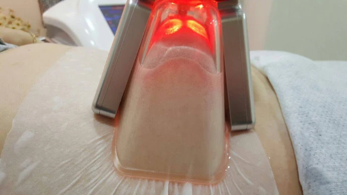 cryolipolysis machine (12).jpg