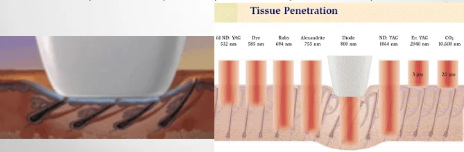 Чем отличается александритовый лазер от диодного. Диодный лазер 808 NM глубина проникновения. Диодный лазер Dio Pro 755/808/1064 что им можно сделать. Глубина проникновения 808 NM.