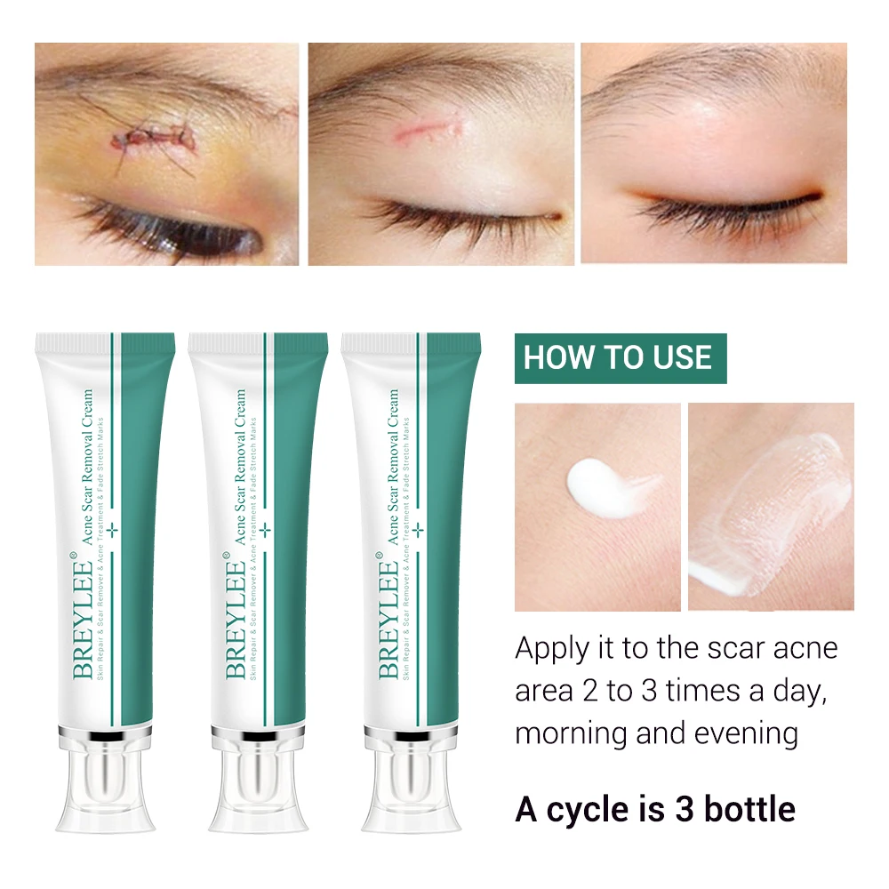Eye Scar Removal Cream 30g Face Cream Skin Care Repair Scar Acne