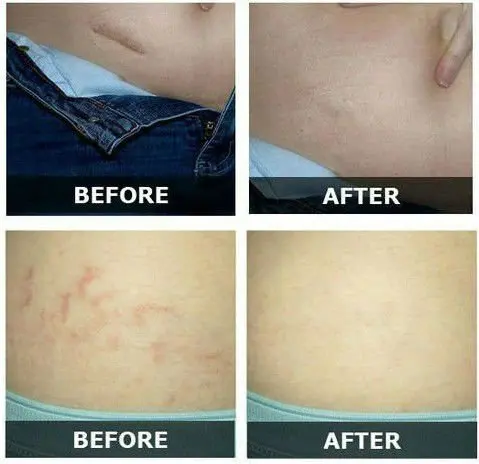 Korea derma pen treatment reslut1.jpg