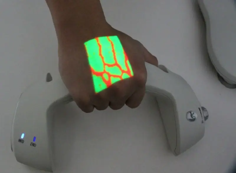 New Blood Vessel Illumination Set for Injection