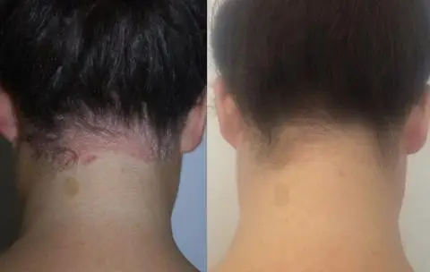 uvb lamps for vitiligo