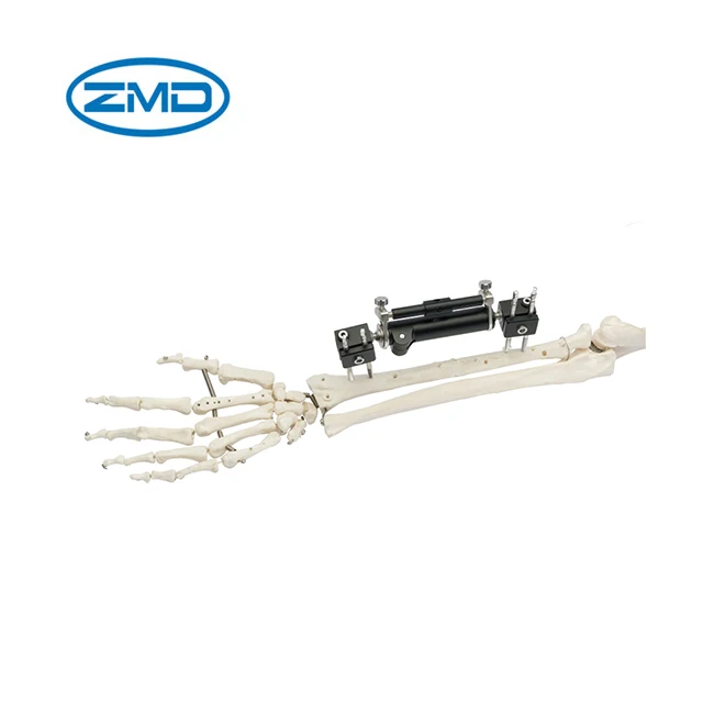 Elbow Joint External Fixator Elbow External Fixation Of Type Buy