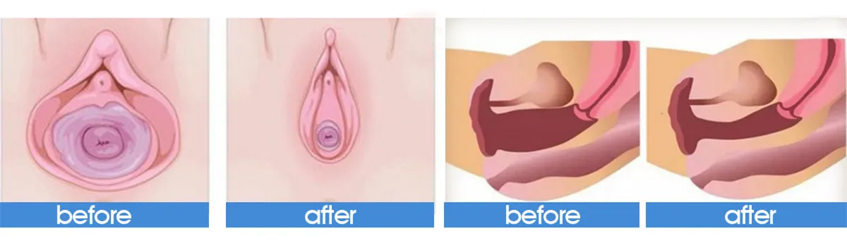 RF Tube  Vaginal Tightening Fractional CO2 Laser With co2 fractional laser