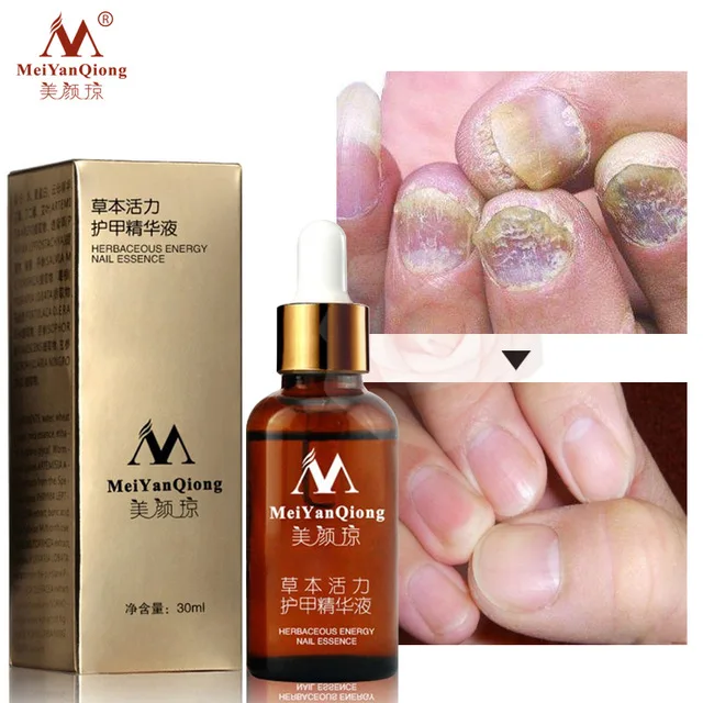 Nail meiyanqiong herbaceous energy essence fungal whitening treatment foot feet care gel shiny 100% Original Meiyanqiong Herbaceous Energy Nail Essence Fungal Nail