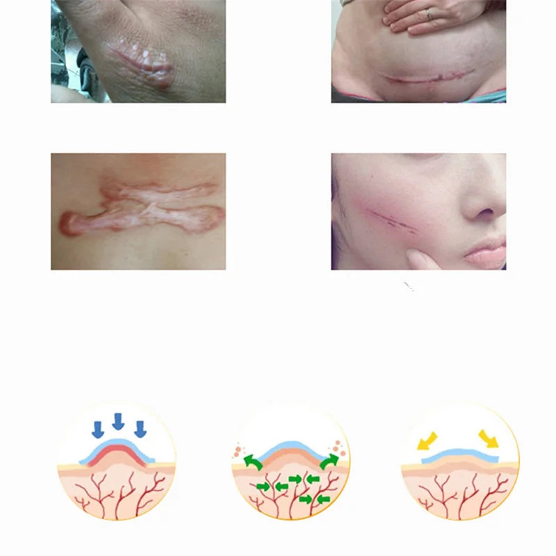 Transparent Silicone scar sheet