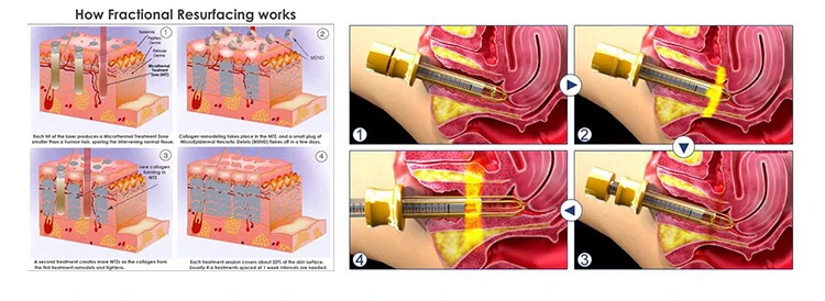 Beijing sincoheren 10600Nm Medical Vaginal Tightening Fractional Co2 Laser Equipment
