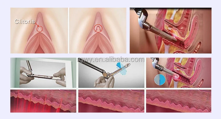 fractional co2 laser equipment