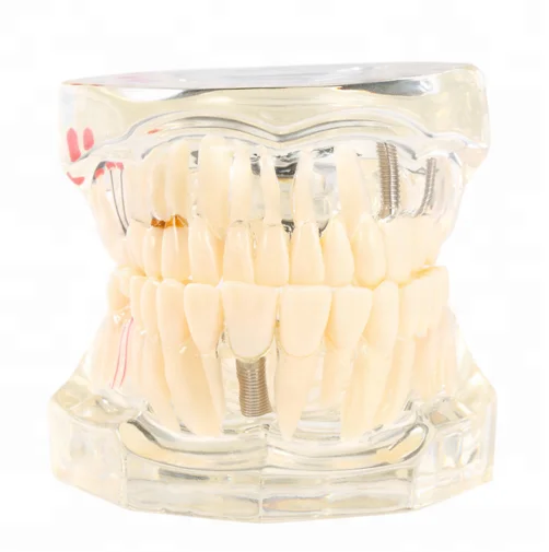
Hot Sale Resin Dental Implant Model 