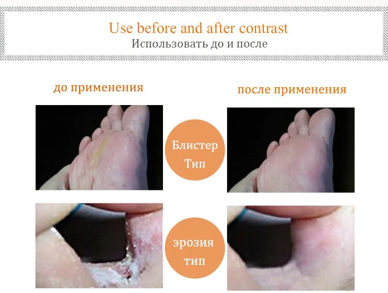 lamisil cream for fingernail fungus