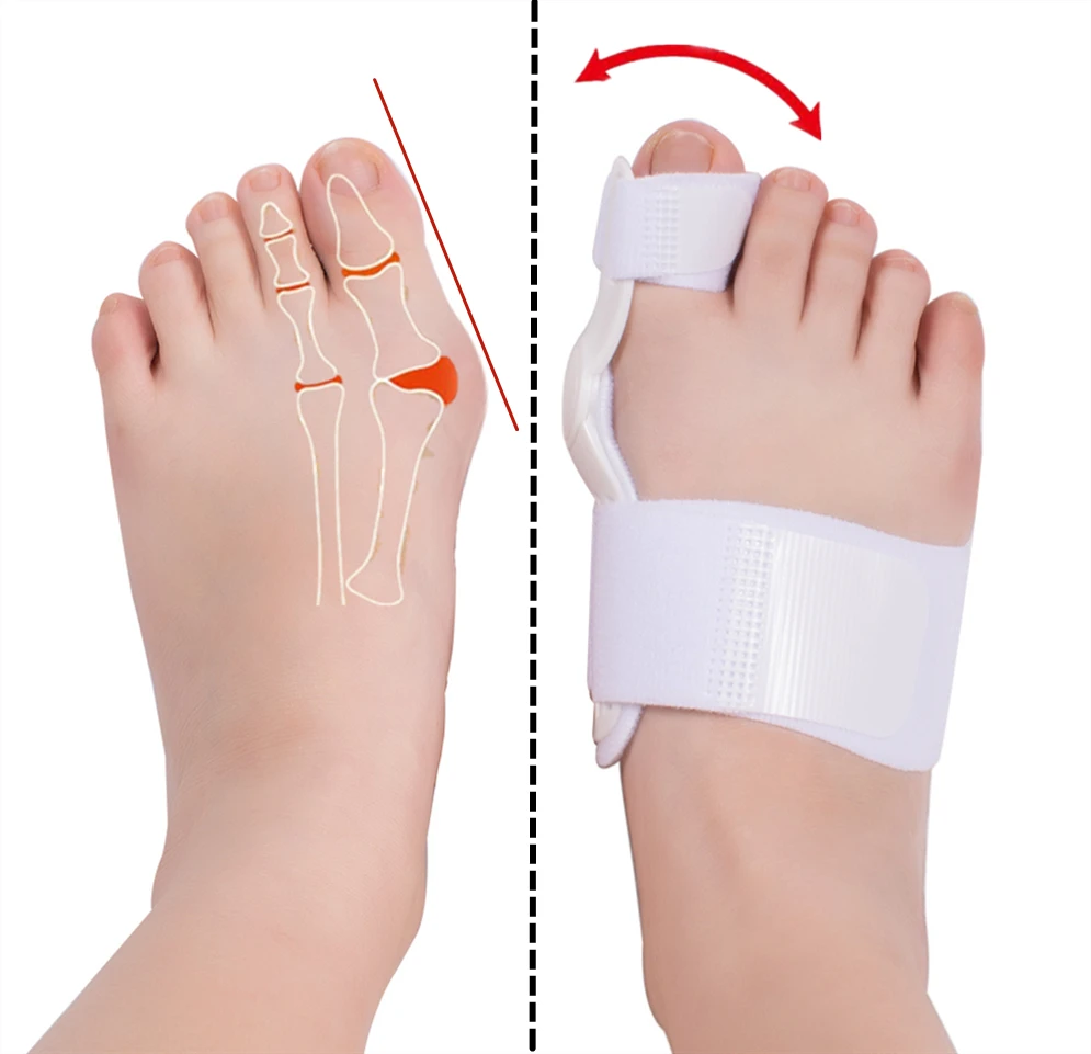 Zrwc19b Gel Metatarsal Pads Bunion Corrector Hallux Valgus Strap Bunion