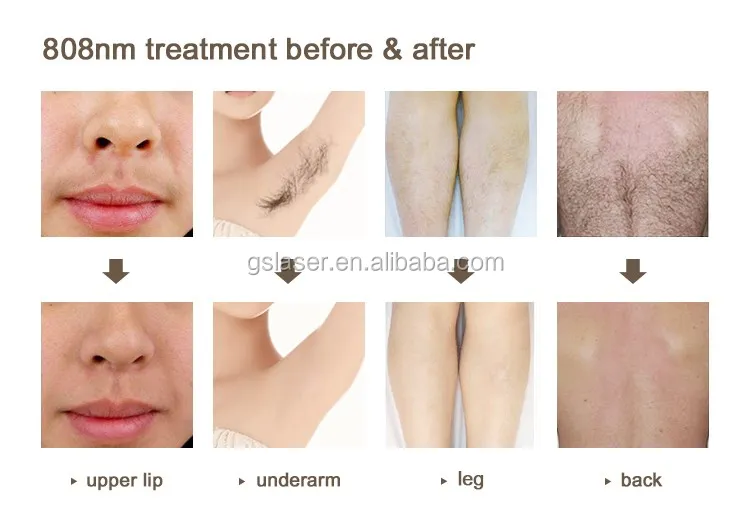 808nm Diode Laser Hair Removal Beauty Care Machine Made In Israel