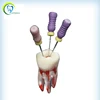 Single Dental Teach Study Adult Standard Artificial Teeth Training Model for Root Canal Therapy