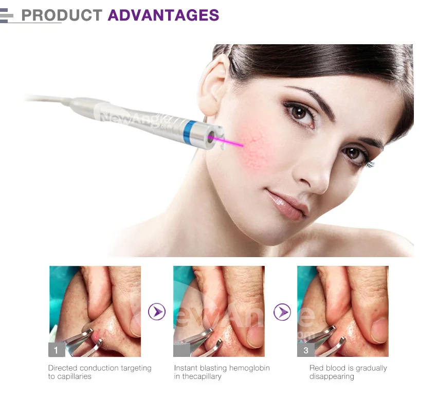 laser spider vein removal.jpg