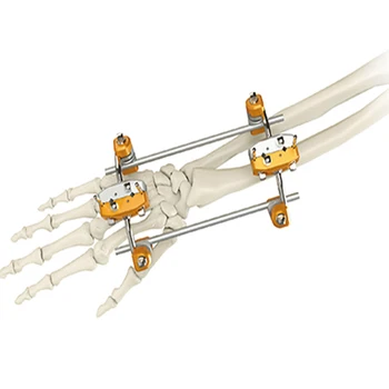 Hoffman Desain Ulna & Radius Spanning Fixator Eksternal 
