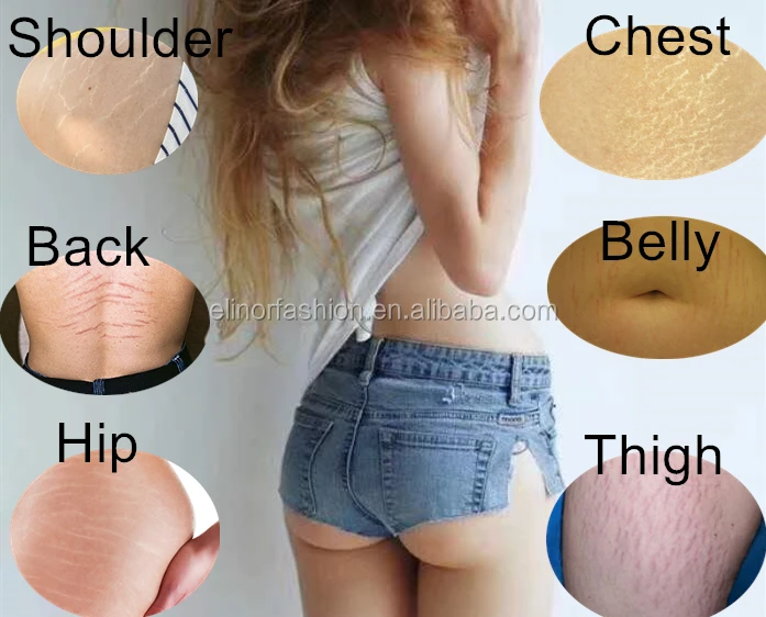 body stretch marks removal cream