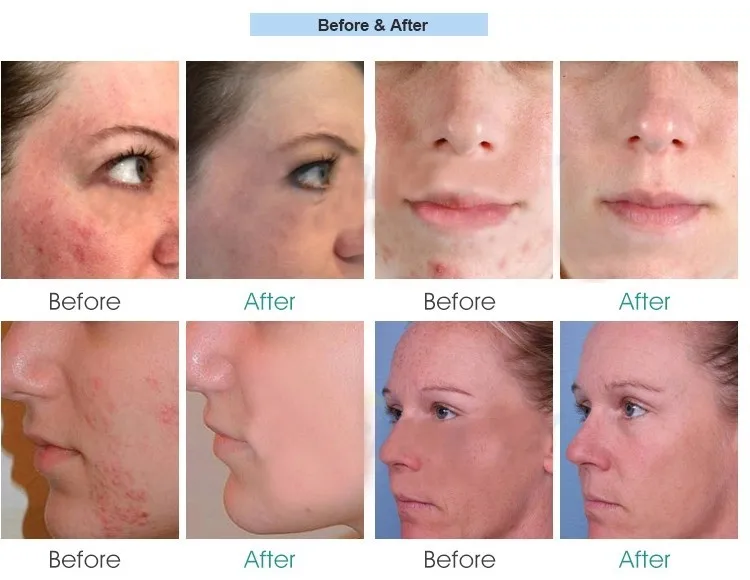 Пустая Капсула Для Лица,Крем,Ампула,Корейский Биоэффект,Биоэпидермальный Фактор 