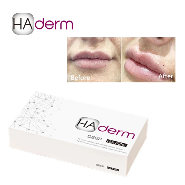 
Injectable Hyaluronic Acid full lips beauty lips 