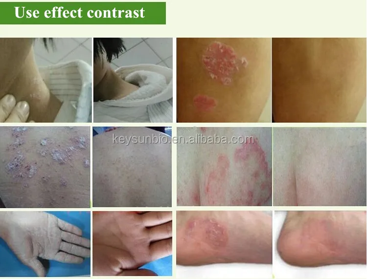 Come curare la psoriasi di unghia
