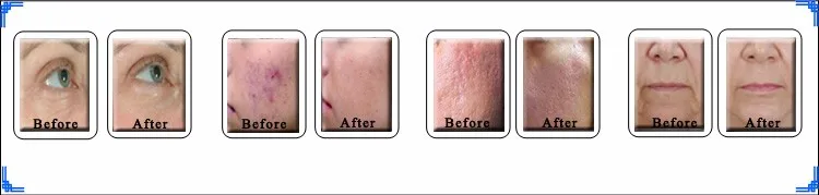 Er: glass laser age spot removal skin treatment beauty machine.jpg