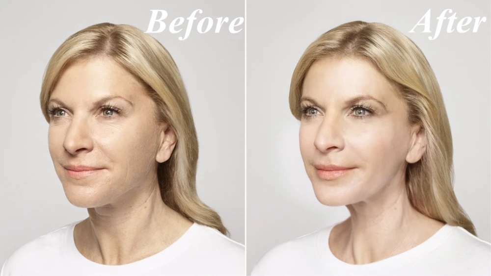 cross linked hyaluronic acid gel2ml hyaluronic acid dermal filler