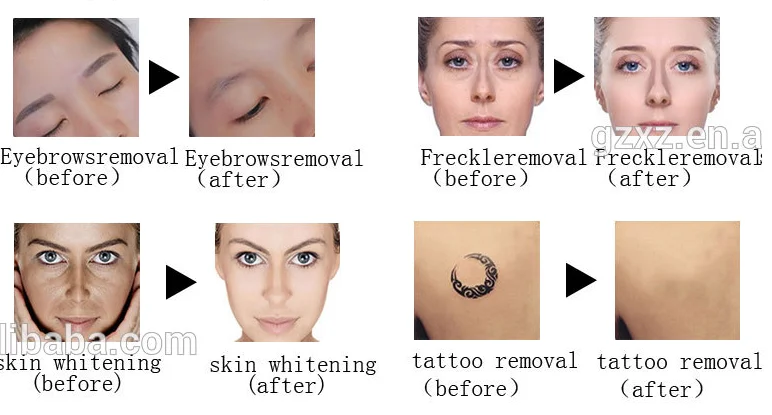 tattoo removal (2).png