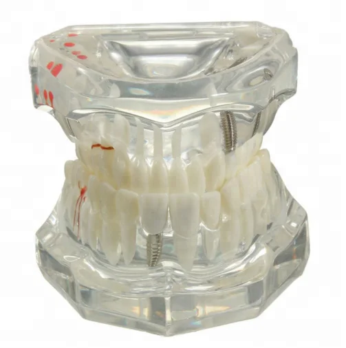 
Hot Sale Resin Dental Implant Model 