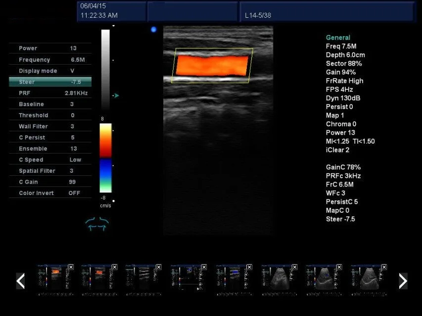Portable 3D Doppler Ultrasound Machine Ultrasonography