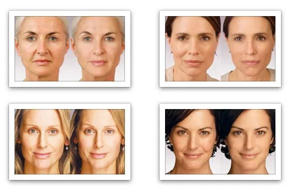 Silhouette thread lift 19g 50mm nose lift thread apto pdo face lift thread