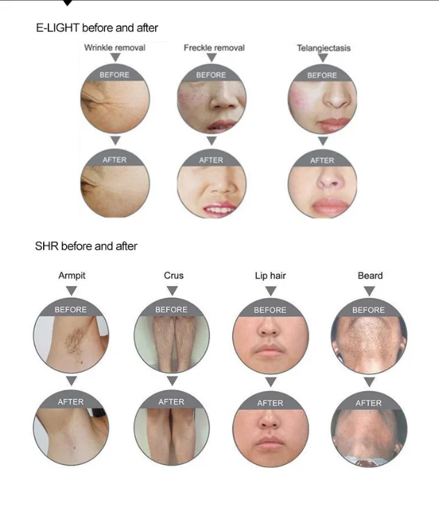 TUV CE 2 handpieces ipl elight laser beauty equipment fast hair removal machine