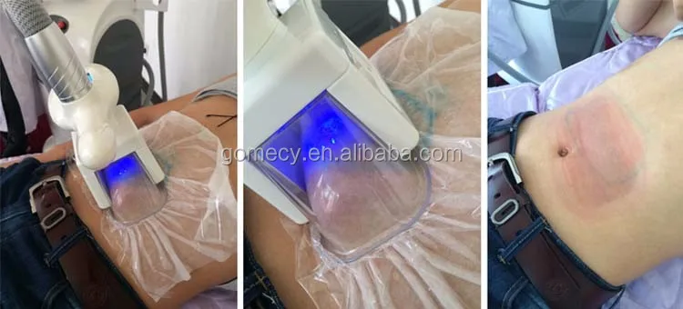 4 Cryo Handle Cryotherapy Sexy Women Body Shape Freeze Fat Machine