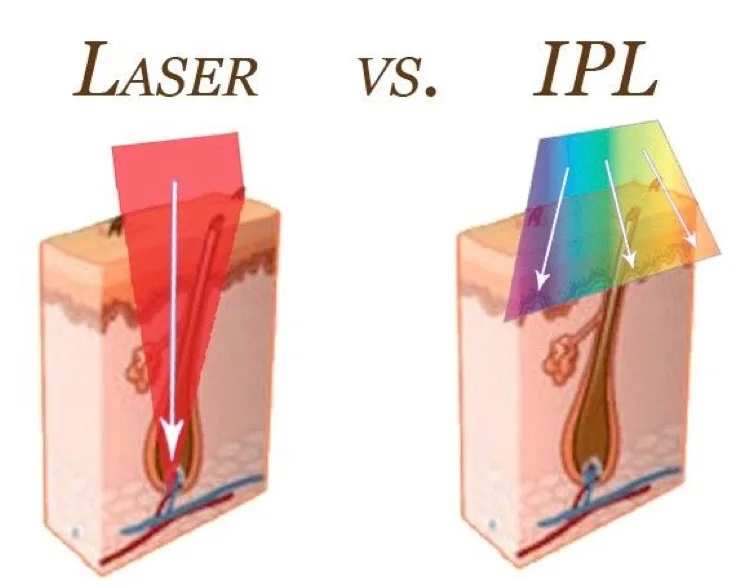 laser VS IPL