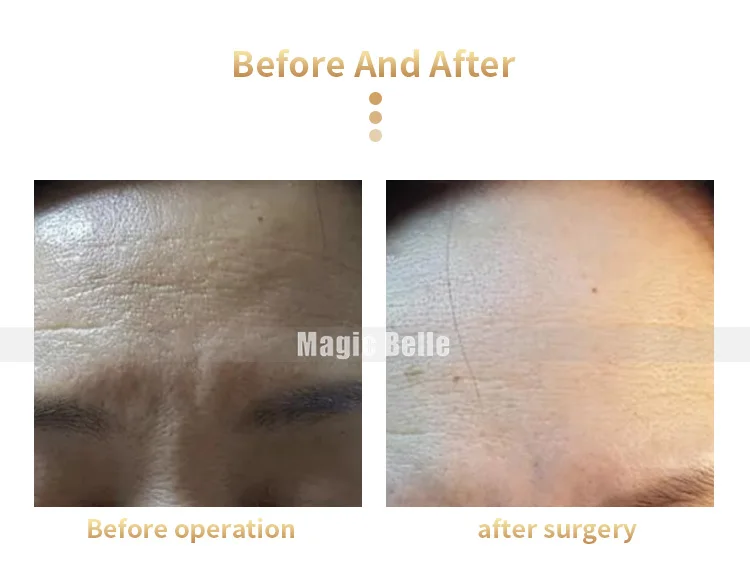 Plasma Jett MA XQ (6)