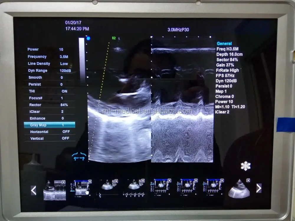 Laptop Doppler Ultrasound Portable Ultrasound Scanner