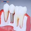 Dental Implant Analysis Crown Bridge Demonstration Teeth Model M2017R/Dental Teeth Model