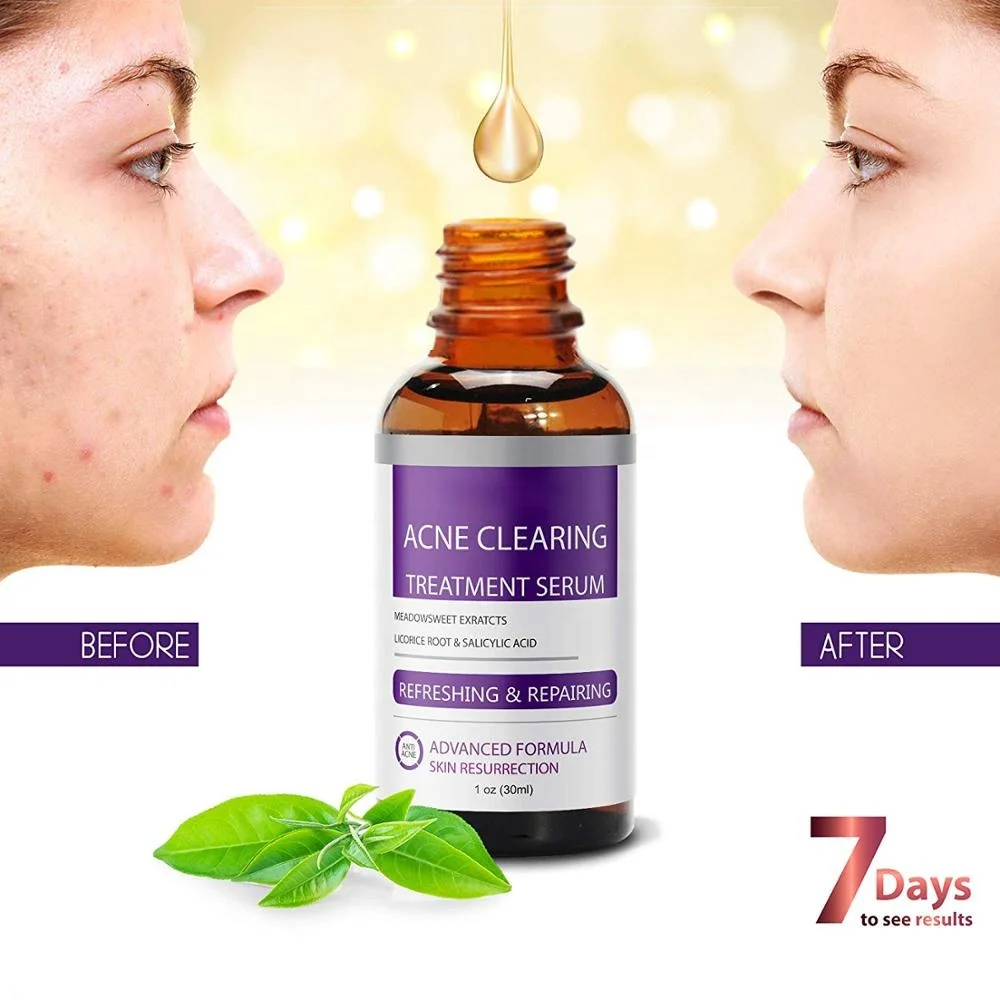 

Tulipano private label natural anti acne serum