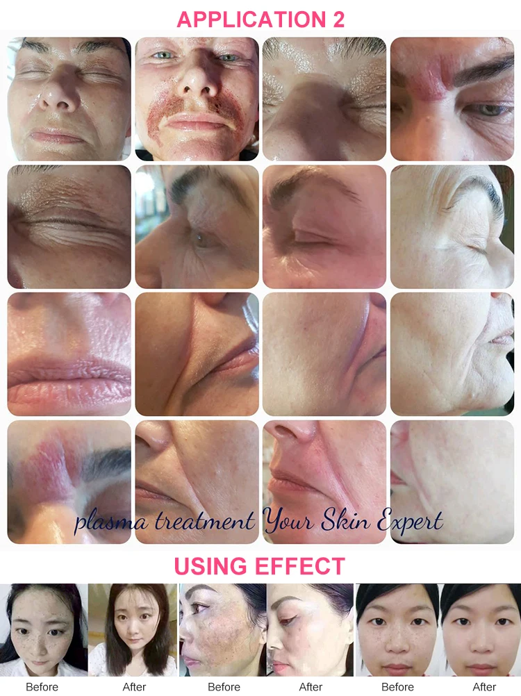 Cheap facial beauty laser natural skin permanent freckle spot mole pen removal