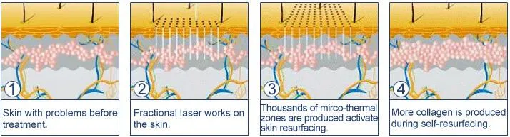 New design Portable Powerful Co2 Fractional Laser Vaginal Tightening Beauty Equipment for Sale