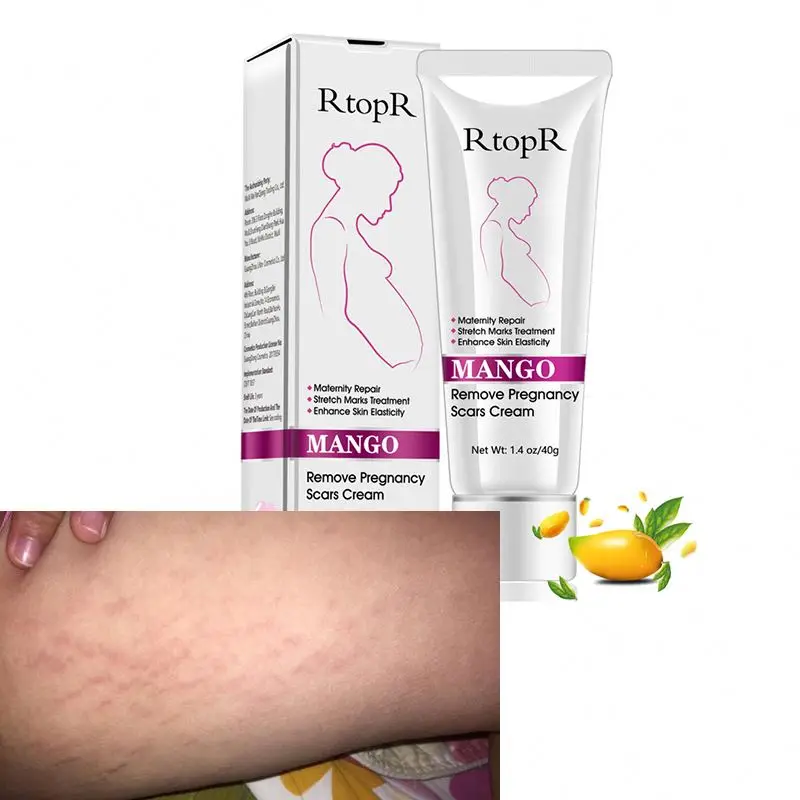 

RtopR Mango Remove pregnancy scars cream Stretch marks treatment skin care cream
