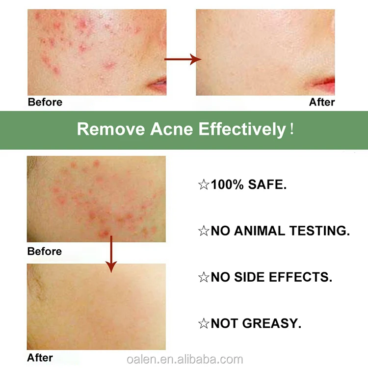 best herbs for acne scars