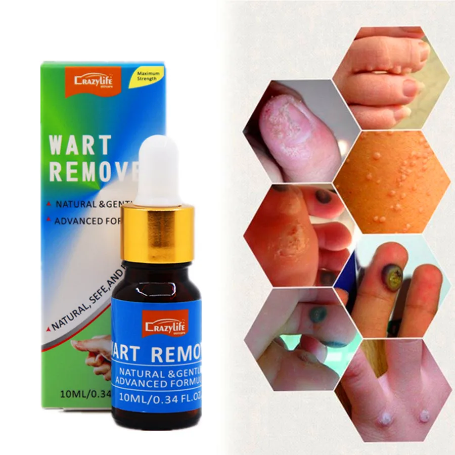10ml Skin Tag Remover Tu Kill Medical Tu Kill Removers Skin Tag Mole Genital Wart Remover Foot Corn Blackhead Remover