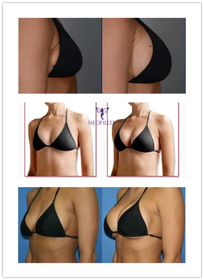 Hyaluronic Acid Injectable Filler Dermal Filler For Breast Buttocks