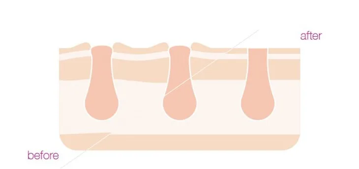 cosbeauty at home permanent commercial 808nm diode laser ipl back body hair removal machine/device price