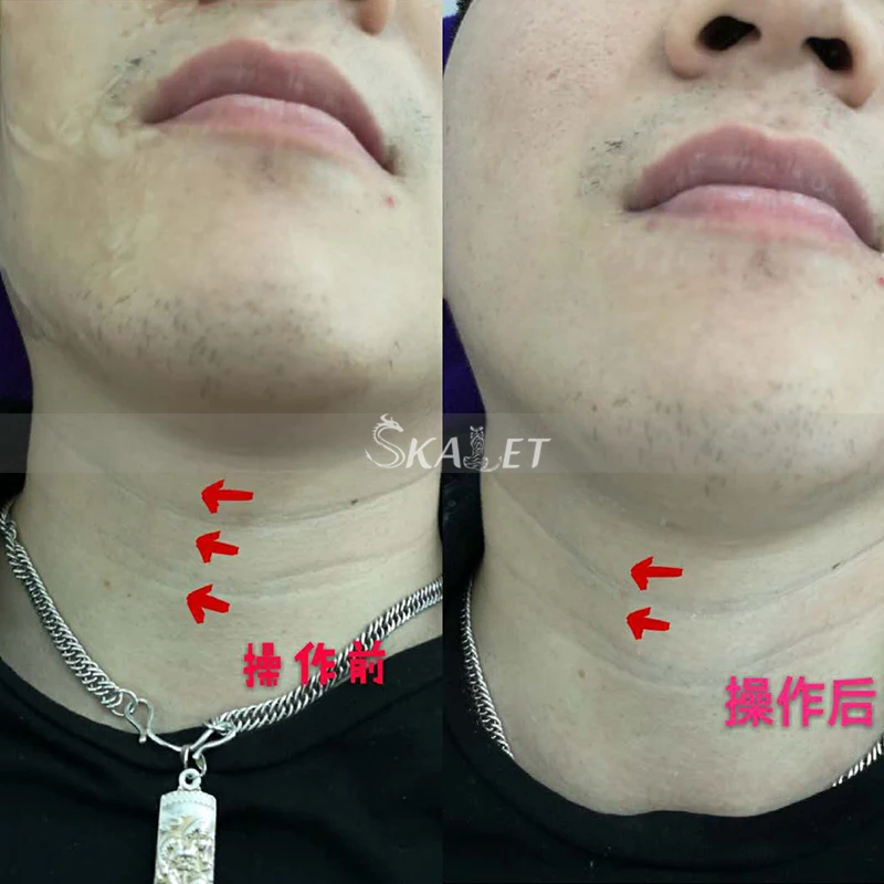 Professional Non-invasive Wrinkle Remover anti-bacterial with CE